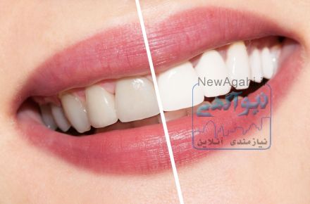 پنج روش در دندانپزشکي زيبايي براي اصلاح طرح لبخند 