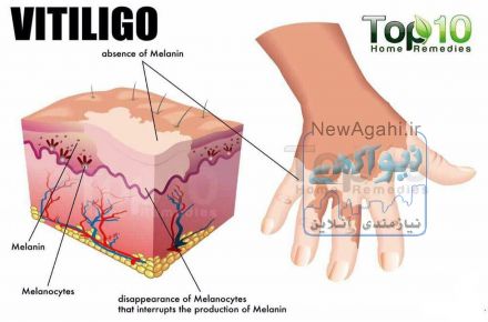 درمان ویتیلیگو(پیسی) با قهوه های گانودرما :)
